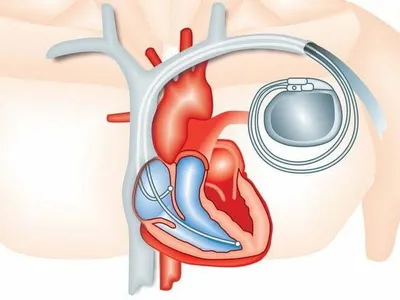 170 de pacienți ar fi „beneficiat” de stimulatoare cardiace şi defibrilatoare de la morți Grafică: Cardioportal.md