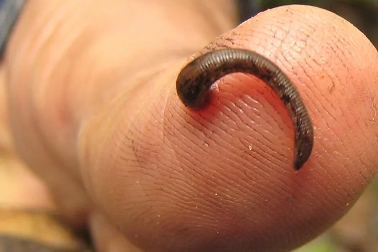 Tratament cu ventuze, lipitori și acupunctură (sursa: mcgill.ca)