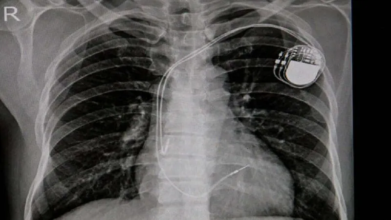 Stimulatoarele cardiace din cadavre, invenție germană (sursa: imperial.nhs.uk)