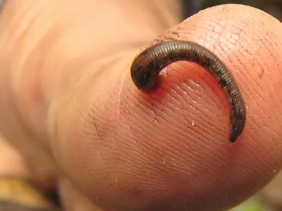 Tratament cu ventuze, lipitori și acupunctură (sursa: mcgill.ca)