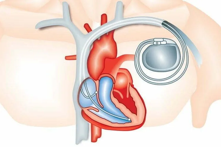 170 de pacienți ar fi „beneficiat” de stimulatoare cardiace şi defibrilatoare de la morți Grafică: Cardioportal.md