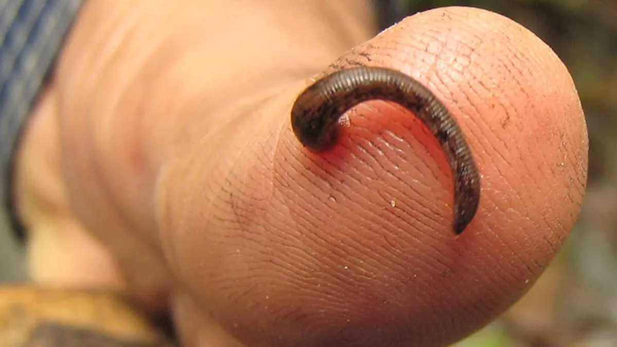 Tratament cu ventuze, lipitori și acupunctură (sursa: mcgill.ca)