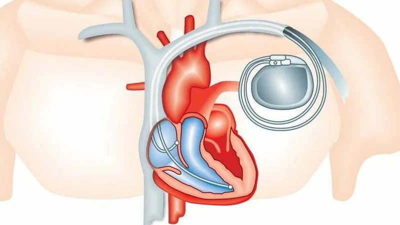 170 de pacienți ar fi „beneficiat” de stimulatoare cardiace şi defibrilatoare de la morți Grafică: Cardioportal.md