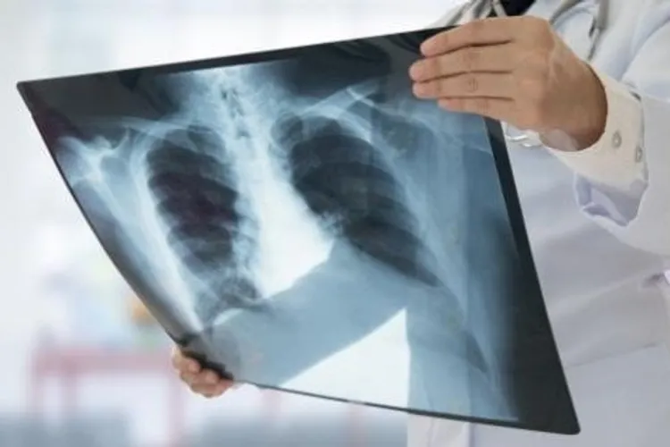 Cazurile de TBC, scădere în pandemie