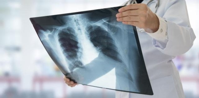 Cazurile de TBC, scădere în pandemie